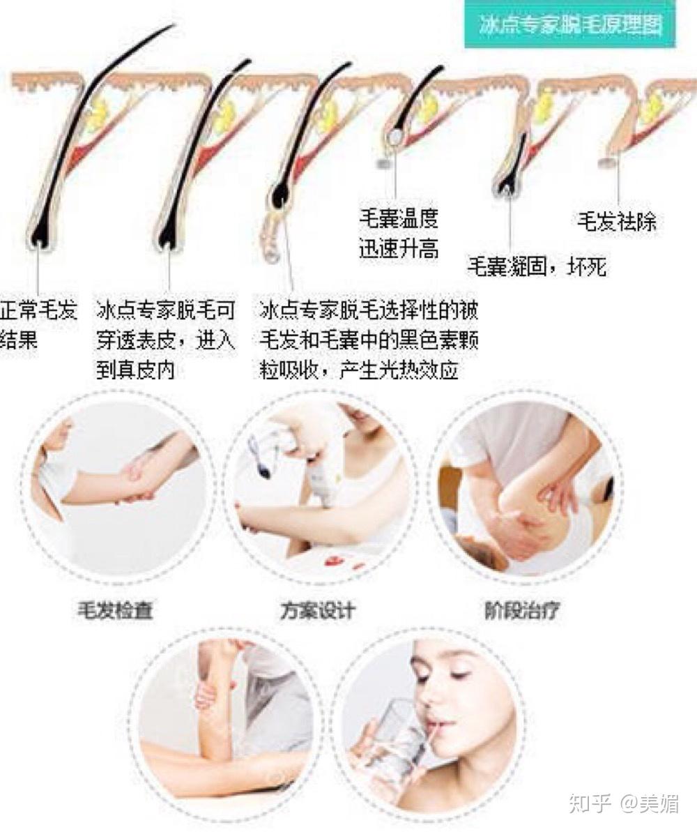 先进脱毛技术概览